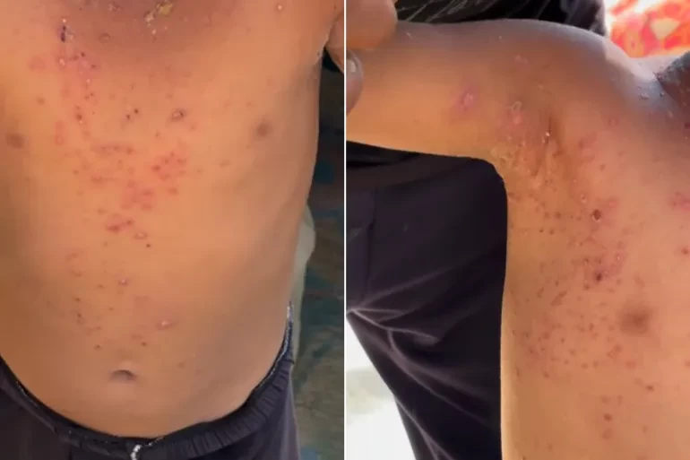 شاهد: شهادات صادمة.. الأمراض الجلدية والتنفسية تغزو أجساد أطفال غزة