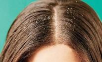وصفات طبيعية للتخلص من قشرة الشعر