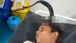 عملية جراحية لاستخراج منجل من رأس مراهق هندى