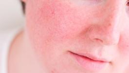 وصفات طبيعية للتخلص من إحمرار الوجه