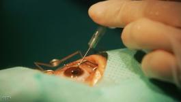 عمليات جراحية في العين .