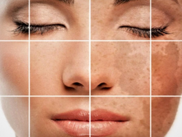 علاج التَّصَبُّغَات الجلدية العميقة بالأعشاب