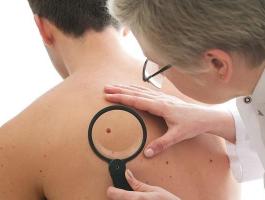 خطير جدا : علامات مبكرة تكشف عن الإصابة بسرطان الجلد.. كيف يكون شكلها؟