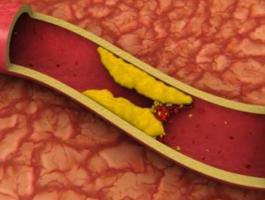 دهون الجسم.. هذا ما تفعله بالشرايين!