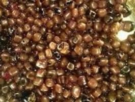 استخراج 475 حصاة من مرارة سيدة مصرية