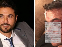 شاهد : أحمد عز يفاجئ الجميع بوجهه المشوّه.. وما حقيقه تعرضه لحادث؟