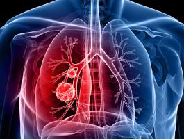 lung-cancer-section