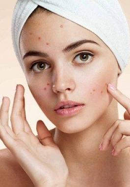 وصفات طبيعية للتتخلصي من آثار حب الشباب