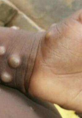 جدري القرود