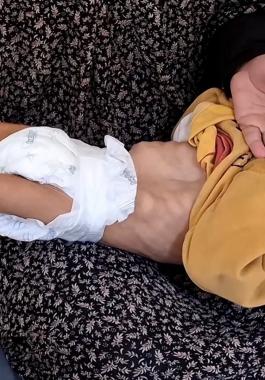 67 طفلاً استُشهدوا في غزة بسبب سوء التغذية جراء الحصار الإسرائيلي