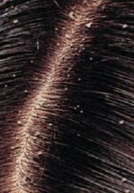 Dandruff_855981_large