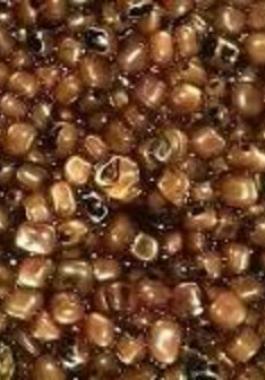 استخراج 475 حصاة من مرارة سيدة مصرية