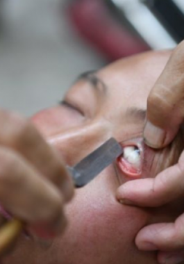 بالصور : عجوز يثير ضجة كبيرة بسبب تنظيفه للعيون باستخدام شفرة حادة!