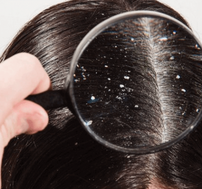 طرق طبيعية للتخلص من قشرة الشعر فى الشتاء