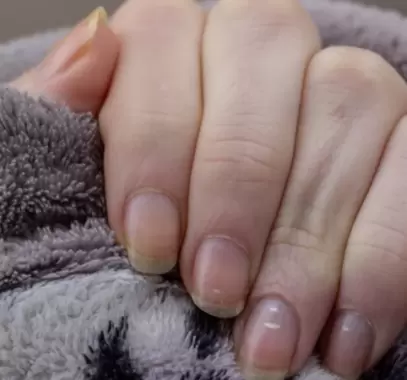 البقع البيضاء على الأظافر..الأعراض والأسباب