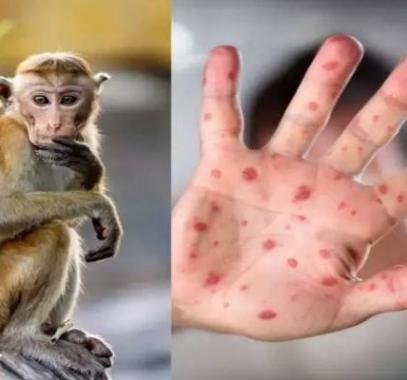 جدري القرود