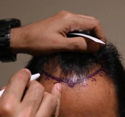 زراعة شعر