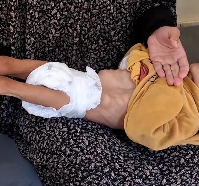 67 طفلاً استُشهدوا في غزة بسبب سوء التغذية جراء الحصار الإسرائيلي