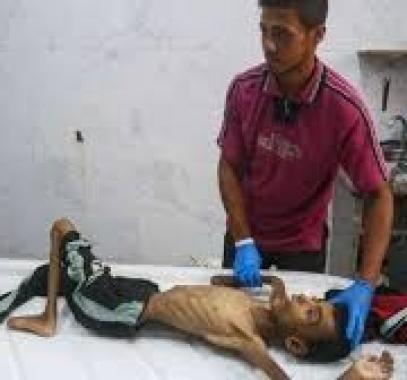 الشلل الرخو