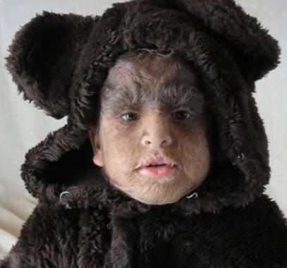 بالصور : عائلة ذئاب بشرية بالمكسيك تكافح من أجل الحياة