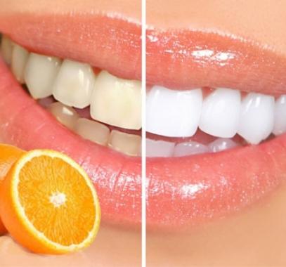 تبيض الاسنان