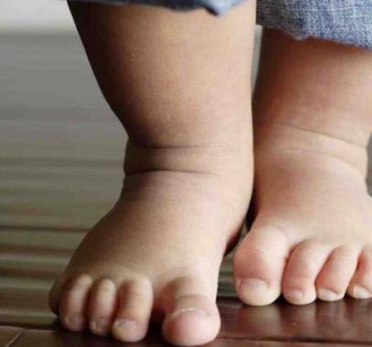 flat-feet-in-children-may-need-attention1-980x490