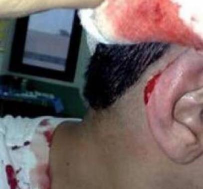 صاحب مطعم يقطع أذن أحد عماله... لأنه طلب إجازة!