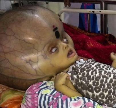 بالصور : هل تذكرون الطفل صاحب أكبر رأس في العالم.. إليكم ما حدث له!