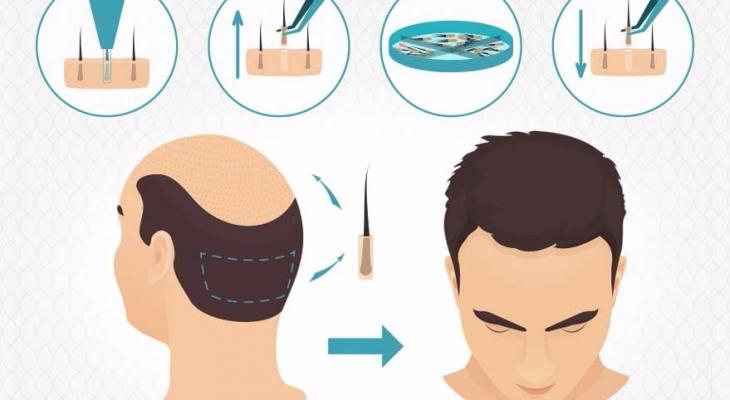 تعرّف على أهم المعلومات بشان عملية زراعة الشعر بتقنية الاقتطاف