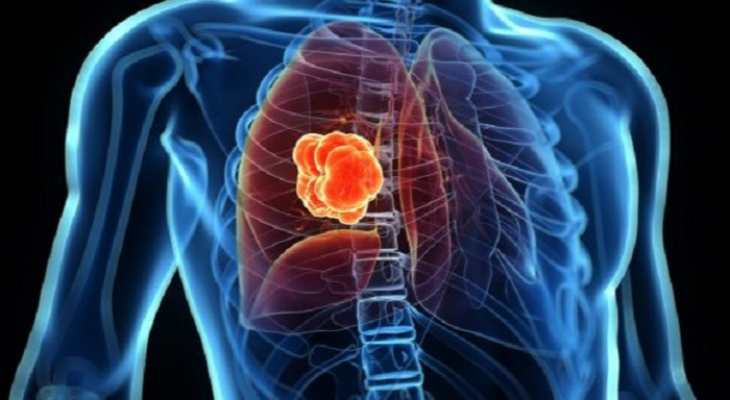 اللبن الزبادي و"سرطان الرئة" دراسة "بالغة الأهمية" للمدخنين