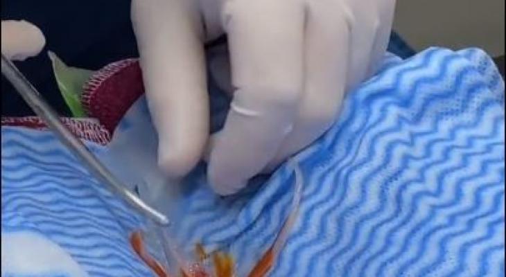 عملية جراحية لسمكة ذهبية بأستراليا لإزالة ورم يحظى بملايين المشاهدات