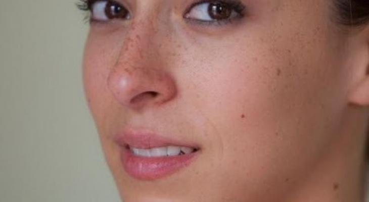 وصفات طبيعية لإزالة النمش من الوجه