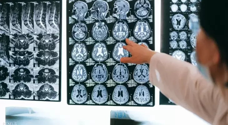 دراسة تكشف تأثير كورونا "المرعب" على المخ والذاكرة