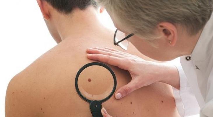 خطير جدا : علامات مبكرة تكشف عن الإصابة بسرطان الجلد.. كيف يكون شكلها؟