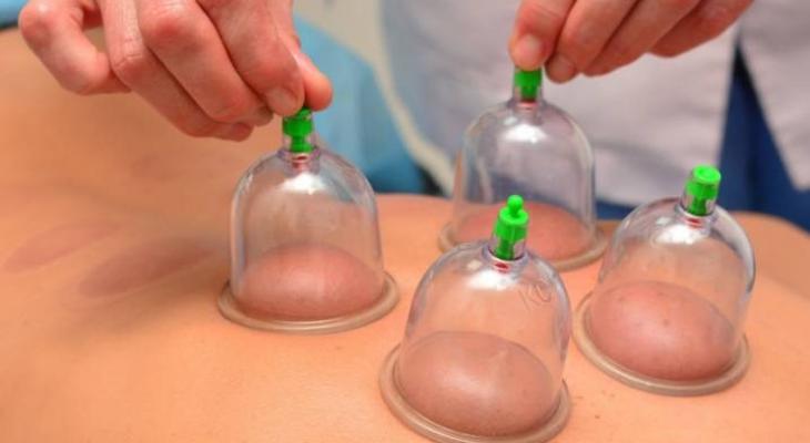 cupping-benefits-jpg-11175610220924331.jpg