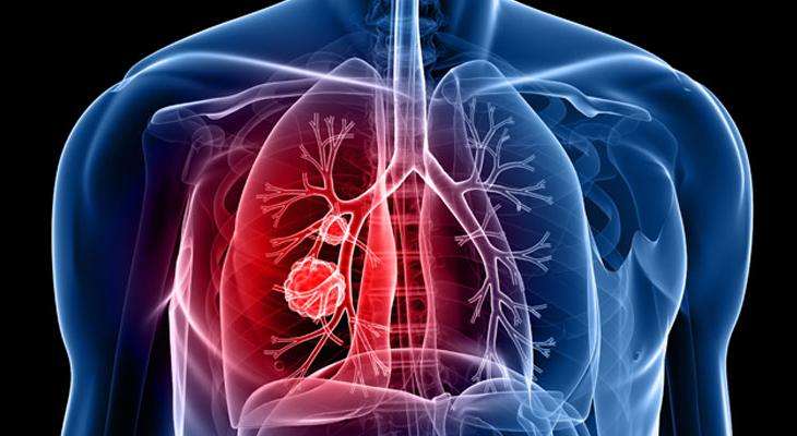 lung-cancer-section