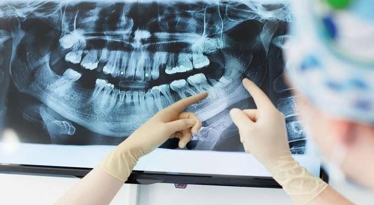 العلماء سبب مرض" ألزهايمر" قد يعيش داخل" فمك"