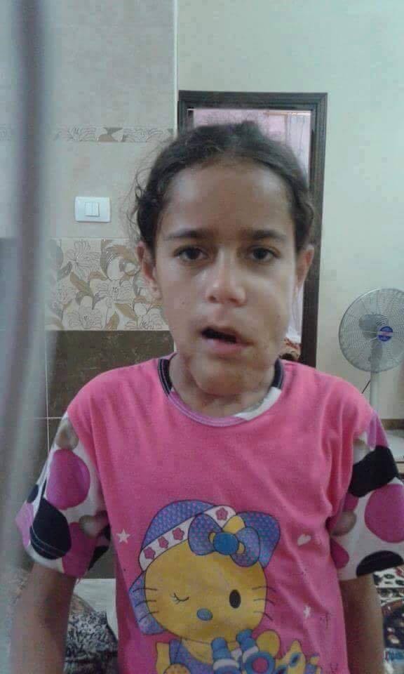 بالصور: الطفلة مريم أسطورة تتحدى المرض في غزّة!