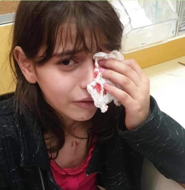 إصابة طفلة مقدسية بجروحٍ بليغة في عينها إثر اعتداء مستوطن عليها