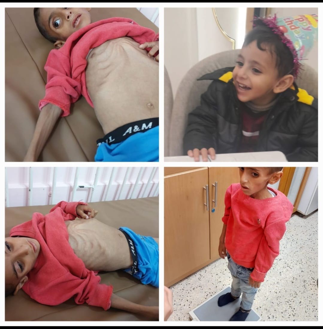 سوء تغذية.jfif