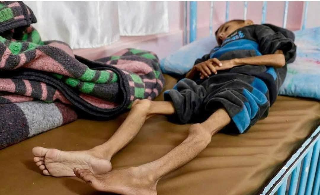 تقرير خاص: غزّة تطرق أبواب المجاعة وتفتحه على مصراعيه وكارثة غير مسبوقة تُدمر ما بقي منها