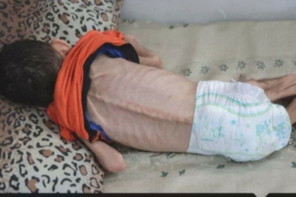 تقرير: غزة.. بطون خاوية وأجساد هزيلة تبحث عن الطعام واحتلال لا يستثني أحد
